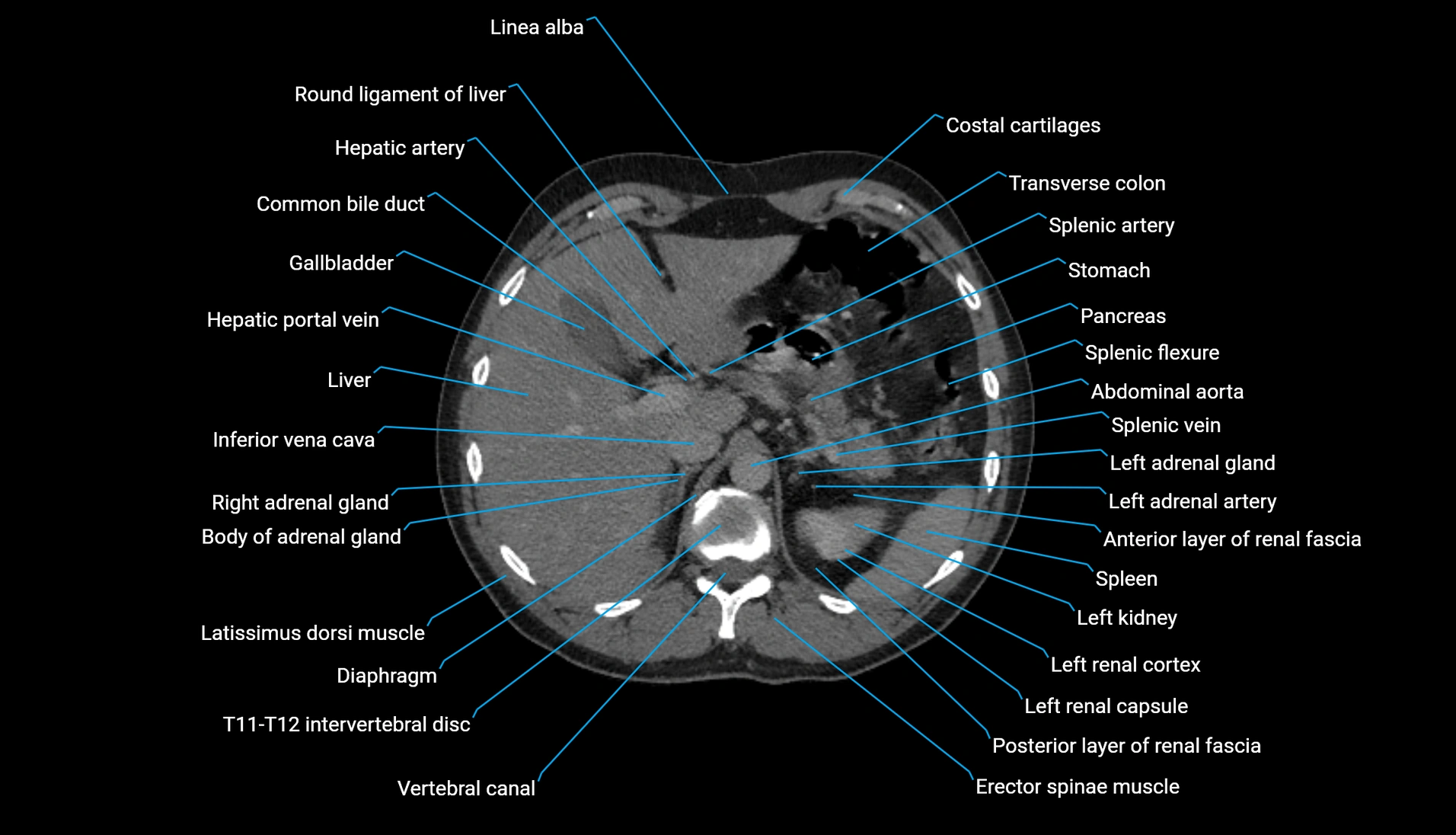 CT urogram axial cross sectional anatomy  labelled radiology image-00072.webp